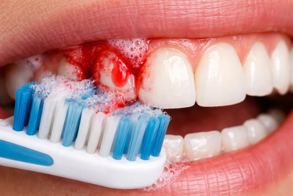 bleeding gums during brushing showing need for dental checkup