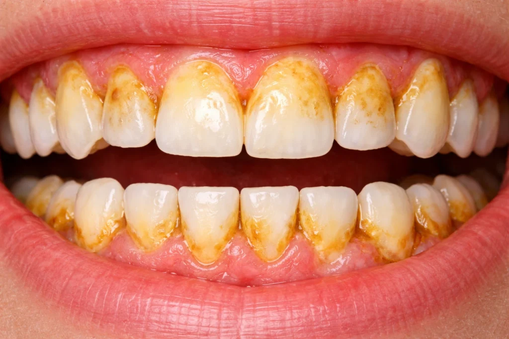 tartar and plaque buildup on teeth during dental checkup examination