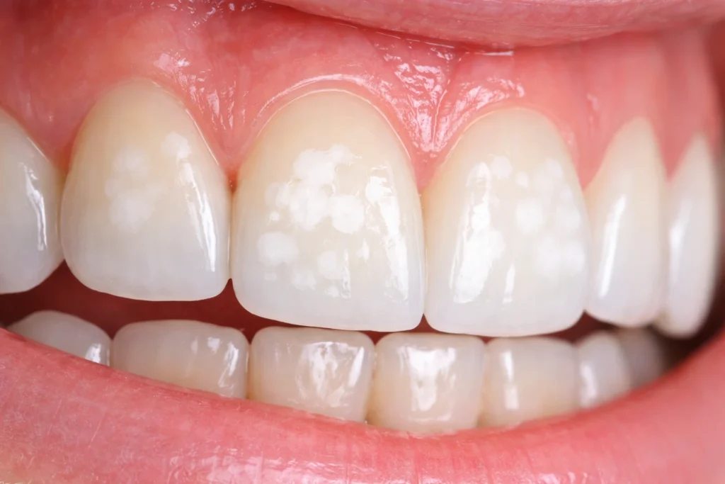 Close-up dental photo showing white spots on tooth enamel, dental fluorosis concept, clinical dental lighting, high resolution realistic dental photography