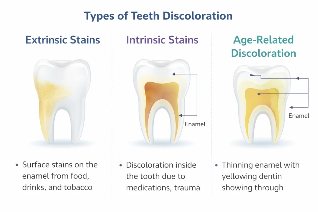 What Causes Teeth Discoloration? Stains, Causes & Fixes