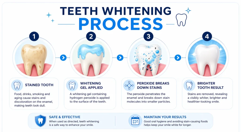 Step-by-step infographic showing the teeth whitening process: stained tooth, whitening gel applied, peroxide breaking down stains, and final brighter white tooth result in a modern dental style.